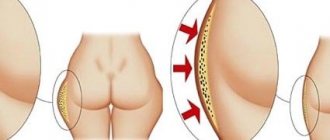 Effective ways to remove glyph on thighs